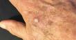 Actinic Keratosis Treatment Market to Grow at 7.1% CAGR Through 2033 | Persistence Market Research