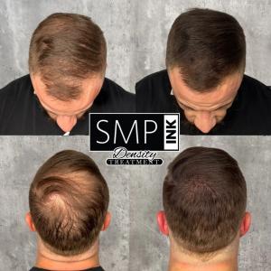 hair density treatment example with SMP INK for a Male