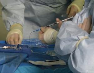 Fluidx Medical Technology, Inc. announced today that the first patient has been treated with the ULTRA Embolic Device. The ULTRA Embolic Device is intended for embolization of hypervascular tumors and blood vessels to occlude blood flow for controlling bleeding in the peripheral vasculature.
Globally, over 5 million embolization devices are used per year, but many of these devices are difficult to visualize, deliver, and control during the procedure. Other embolics have poor visibility, require complex preparation, and rely on difficult delivery techniques.
The ULTRA Embolic Device was successfully used to treat an angiomyolipoma (AML) tumor. AMLs are the most common, solid renal tumor affecting between 0.3% and 0.6% of the global population.
“We are pleased with how controlled the material delivery was,” said Andrew Holden, M.D., Principal Investigator at Auckland City Hospital, in Auckland, New Zealand. “A testament to the technology, we felt comfortable delivering it in a difficult anatomical setting. We could see the material very well as it filled the vessel segment, completely blocking blood flow to the target area.”
“The ULTRA Embolic Device was designed to provide maximum control to the physician,” said Russ Bjorklund, Vice President, Fluidx Medical Technology, Inc. “Embolics should have consistent performance to maximize patient safety, be fast to prepare to reduce case times, and deliver complete results.”
About Fluidx Medical Technology:
Fluidx Medical Technology, Inc. is a Salt Lake City, Utah based company focused on developing a new, innovative category of easy to use, controllable embolic gels that can treat the widest range of clinical conditions, effectively occluding the smallest vessels up to the largest vessels. The current pipeline includes the GPX, ULTRA, and IMPASS embolic technologies with applications across peripheral vascular, interventional oncology, and neurovascular embolization. Unlike other embolic devices, the Fluidx Medical Technology portfolio does not use toxic dimethyl sulfoxide (DSMO) or other precursors, glue catheters into the body, require special delivery systems, or need special mixers and preparation stations.
GPX, ULTRA, and IMPASS Embolic Devices are under development, described and shown for research, educational, and engineering use only, and do not have marketing clearance or approval in any market at this time.
www.FluidxMedical.com Image of the ULTRA Embolic Device being used by physicians in a case