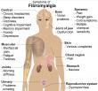 Fibromyalgia Treatment Market Set for 5.4% CAGR Through 2033 | Persistence Market Research