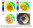Brisbane Surgeons Publish World-First Nomogram for Corneal Ring Segment Treatment of Keratoconus