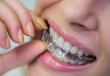 Invisalign in Beverly Hills Continues to Rise in Popularity among Adults
