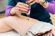 Akribis Veins & Vitality Highlights Advances in Laser Tattoo Removal Technology in Worthington, Ohio