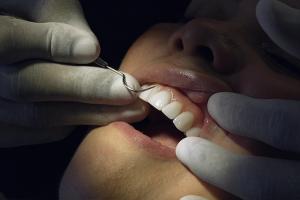 Ultra-thin Veneers