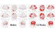 U: The Mind Company Published Study Shows ~580% Increase in Memory Brain Activity in Alzheimer’s Patients w/No Surgery 