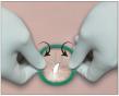 Plastic Wound Retractor Market Demand Rising Steadily with 3.3% CAGR Forecast by Persistence Market Research