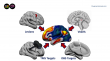 How strokes that trigger psychiatric symptoms are guiding new approaches to brain stimulation therapy