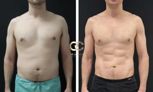 high-definition liposuction male before and 8 years after showing long-term abdominal definition and body contouring results