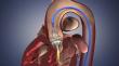 TAVR Market Valued at US$ 7.1 Bn in 2026, Forecast to Reach US$ 11.3 Bn by 2033 | Persistence Market Research