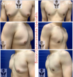 Boston Gynecomastia Specialists establishes itself as the region’s premier dedicated Male Breast Reduction practice