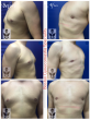 This Men's Mental Health Month, Boston Gynecomastia Specialists highlights Gynecomastia’s impact on men’s mental health