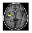 New Chinese Neurosurgical Journal Study Report Novel Surgical Strategy for Moyamoya Disease