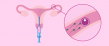 Artificial Insemination Market to Reach US$ 4.2 Bn by 2033 | Persistence Market Research