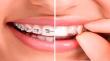 Invisible Orthodontics Market Size to Hit US$99.1 Bn at 28.9% CAGR | Persistence Market Research
