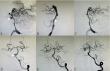 Chinese Neurosurgical Journal Study Finds Most Basilar Trunk Aneurysms Treatable with Minimally Invasive Techniques