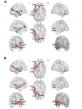 Chinese Neurosurgical Journal Study Shows Heat-Based Therapy Alters Epilepsy Brain Networks