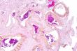  Chinese Neurosurgical Journal Reports KRAS Gene as Key Driver for Brain Arteriovenous Malformation