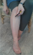 Daily self-moxibustion during chemotherapy found to be feasible and acceptable