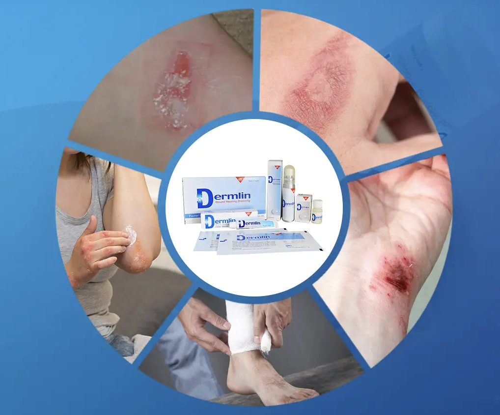 Yenssen Biotech Expands Global Reach, Seeks Distribution Partners for CE- and FDA-Cleared Advanced Wound Care Products