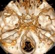 Chinese Neurosurgical Journal Article Finds That Flow Diversion Devices are Exceptionally Safe
