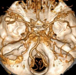 Intracranial aneurysms are a silent and dangerous vascular disorder where the wall of a major artery in the brain weakens and swells Flow diversion devices are a safe long-term treatment for intracranial aneurysm