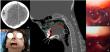 A Chinese Neurosurgical Journal Study Explores Traumatic Epidural Hematoma Management Strategies in a Progeria Patient