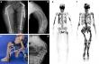 RNA Editing Enzyme Reprograms Aggressive Bone Cancer Cells