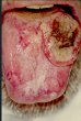 New Insights into Oral Cancer Without Traditional Risk Factors