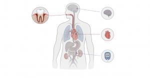 Most people think of gum disease as a dental problem Infographic showing connections between periodontal disease and the brain, heart, and pancreas through inflammatory pathways.