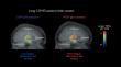 Brain inflammation is unlikely to explain persistent long COVID symptoms