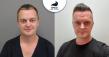 Haartransplantation Türkei vs. Deutschland vs. Ungarn: Was kostet eine Behandlung wirklich?