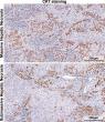 Massive Hepatic Necrosis Drives Acute Liver Failure: Mechanisms, Challenges and Clinical Potential