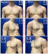 Boston Gynecomastia Specialists Report Sheds Light on the Link Between Bigorexia / Muscle Dysmorphia and Gynecomastia