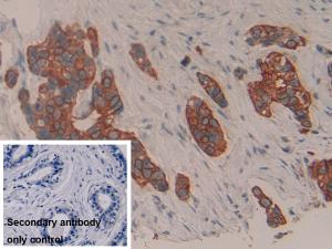 Figure 2: IHC detection results of CK7 marker in human breast cancer tissue