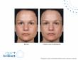 Laser Cliniqué Launches Clear + Brilliant Touch Laser, Bringing San Diego's Most In-Demand Skin Rejuvenation Treatment