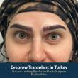 Eyebrow Transplant in Turkey Emerges as a Rising Force in Global Health Tourism