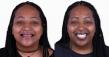 Esthetic Dentistry Puerto Vallarta Releases Dental Implant Pricing Breakdown for Patients Considering Mexico