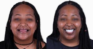 Case of full mouth dental implants in Mexico , performed at Esthetic Dentistry Puerto Vallarts