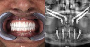 Full mouth rehabilitation case