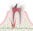 Novel Bioengineered Peptide May Offer a Regenerative Solution for Dentin Hypersensitivity