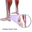 Aging-Linked Cells Emerge as Unexpected Allies in Tendon Healing