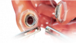 Promising Results in First-in-Human Study, Self-Forming Magnets for Compression Anastomosis in Colorectal Surgery