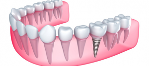 Dental Implant Cost in Sydney