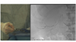 Fluidx Announces Continued Clinical Success with ULTRA Embolic Gel