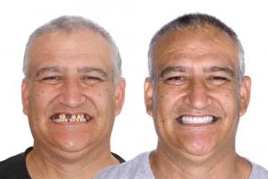 Dental Implants Treatment at Perth Dental Rooms