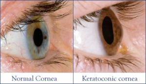 Queratocono y Astigmatismo en Jóvenes Topografía Corneal