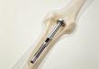 China Intramedullary Nails and Cannulated Screws Suppliers for Argentina’s Trauma Surgery Market