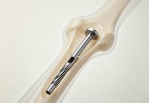 Intramedullary Nails and Cannulated Screws