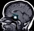 Chinese Neurosurgical Journal Study Updates Guidelines for Prolactinoma Care