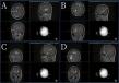 Chinese Neurosurgical Journal Highlights Robot-Guided Approach for Complex Brain Abscesses